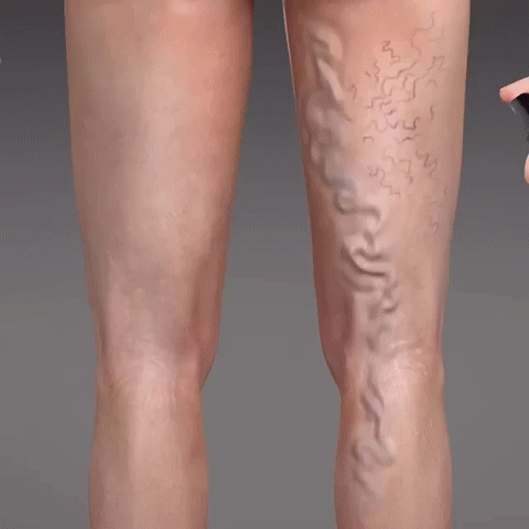 Herbal Varicose Vein Relief Spray 🌿 | Easy Spray-On for Leg Comfort, Swelling & Appearance ✨