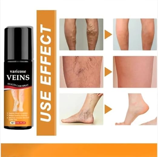 Herbal Varicose Vein Relief Spray 🌿 | Easy Spray-On for Leg Comfort, Swelling & Appearance ✨