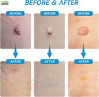 2 in 1 Skin Tag Remover Kit - Painless