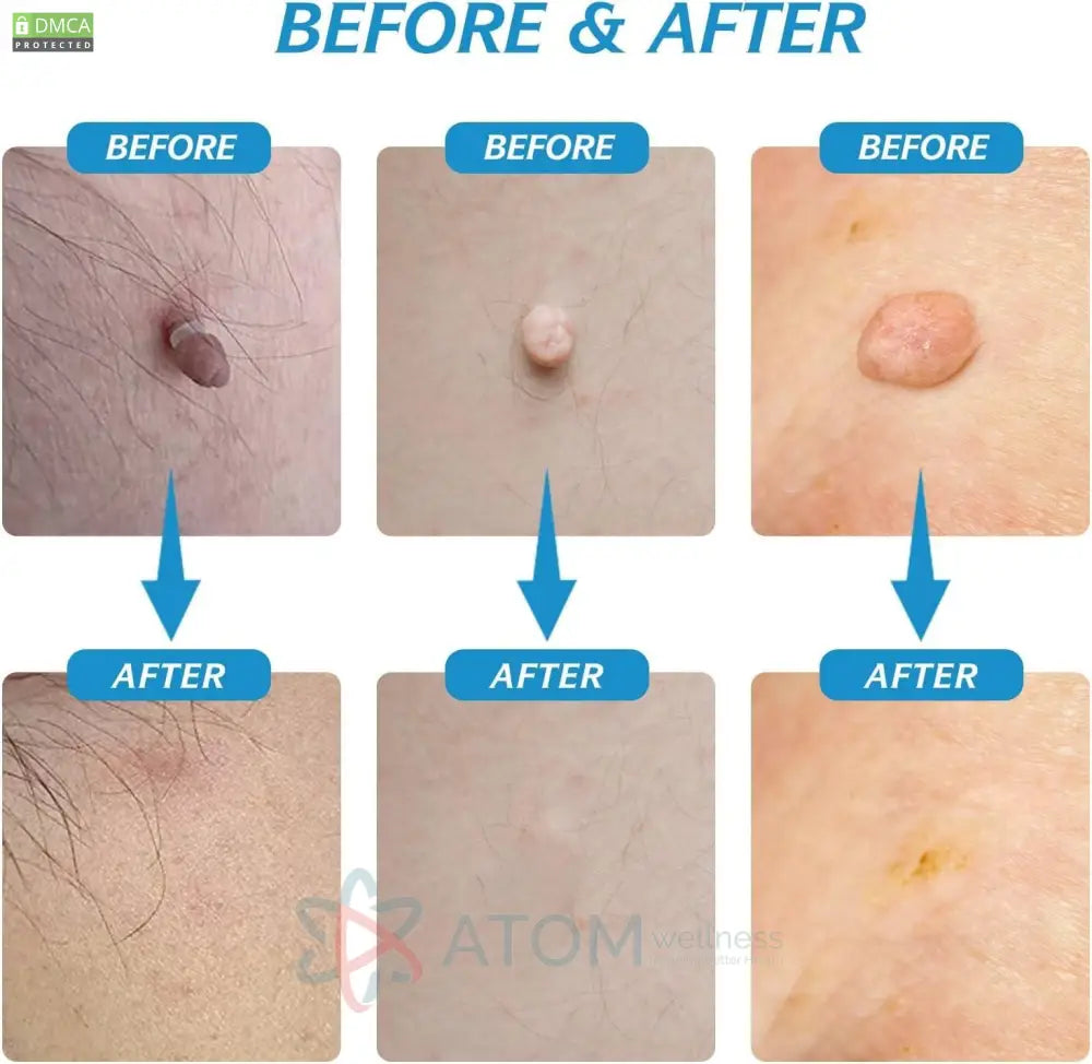 2 in 1 Skin Tag Remover Kit - Painless