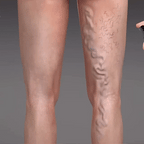 Herbal Varicose Vein Relief Spray 🌿 | Easy Spray-On for Leg Comfort, Swelling & Appearance ✨