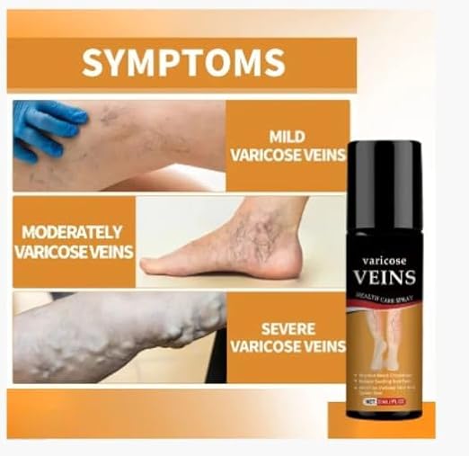 Herbal Varicose Vein Relief Spray 🌿 | Easy Spray-On for Leg Comfort, Swelling & Appearance ✨